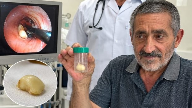 6 ay ağciyərində bu bitki ilə yaşadı &ndash; həqiqət xəstəxanada üzə çıxdı