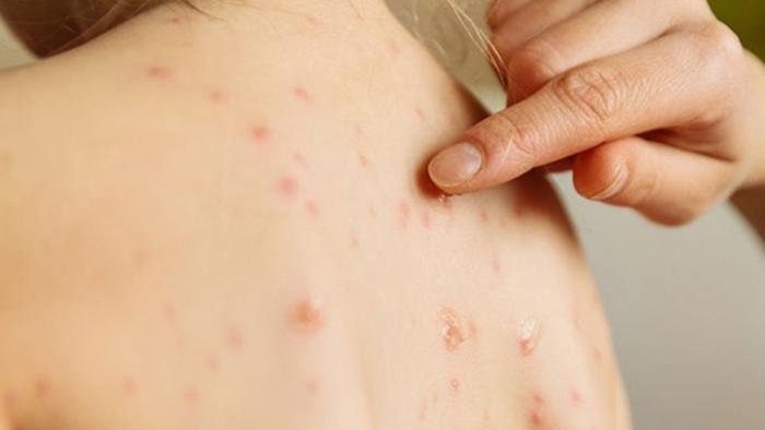 Uşaqlar arasında suçiçəyi yayılıb? &ndash; RƏSMİ AÇIQLAMA