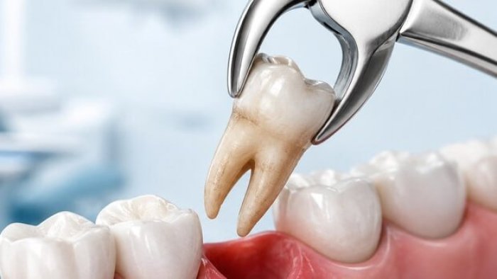 Stomatologiyanın “səhnə arxası” – Çəkilən çürük dişlər hara gedir?